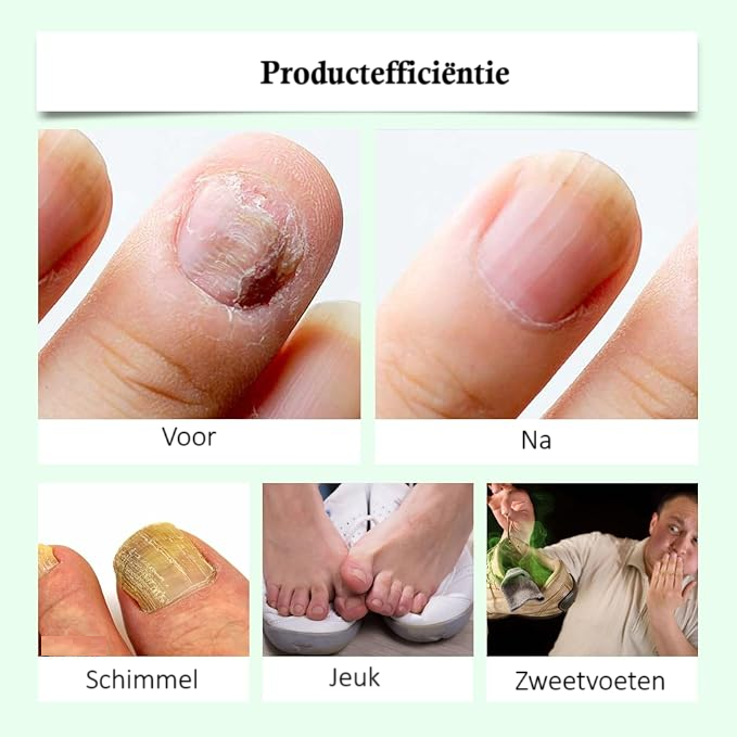 NailDrops 2+1 GRATIS: Vloeibare Nagelschimmelherst Reparatieellende Druppels